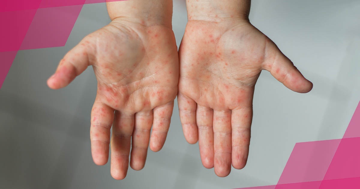 В Україні спалах вірусу Коксакі: все, що потрібно знати про небезпечну лихоманку